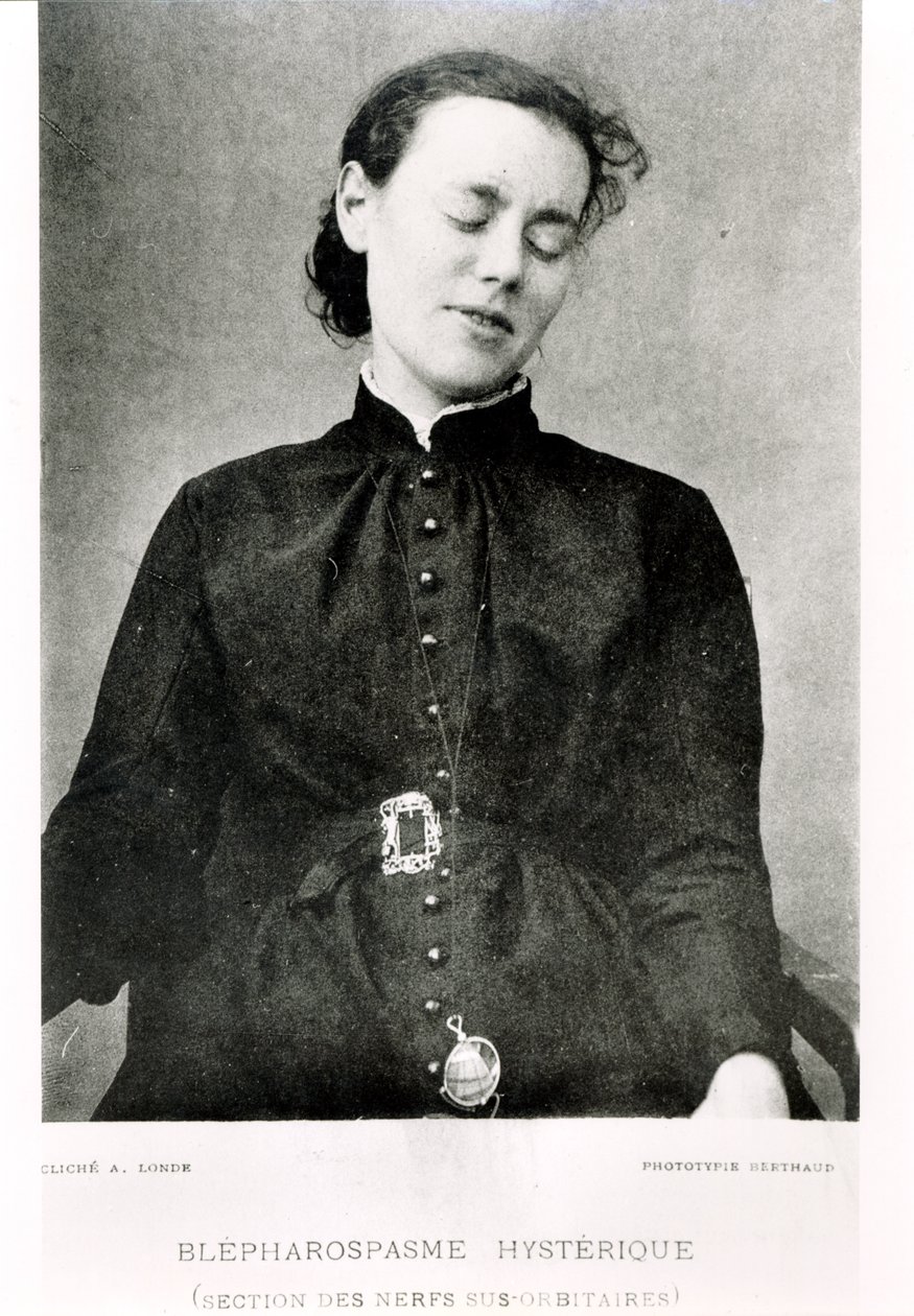 由Jean Martin Charcot教授（1825-93）于1889年在巴黎出版的“新的Salpetriere图像”中的非自愿眼睑痉挛 作者 阿尔伯特·朗德