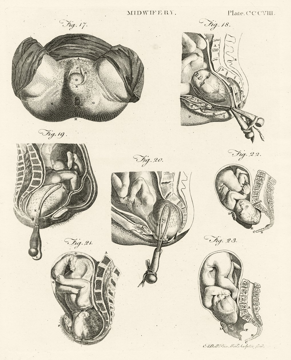 助产士，插图来自&39;Encyclopedia Britannica&39;，于1798年在爱丁堡出版（铜版画） 作者 亚历山大·贝尔