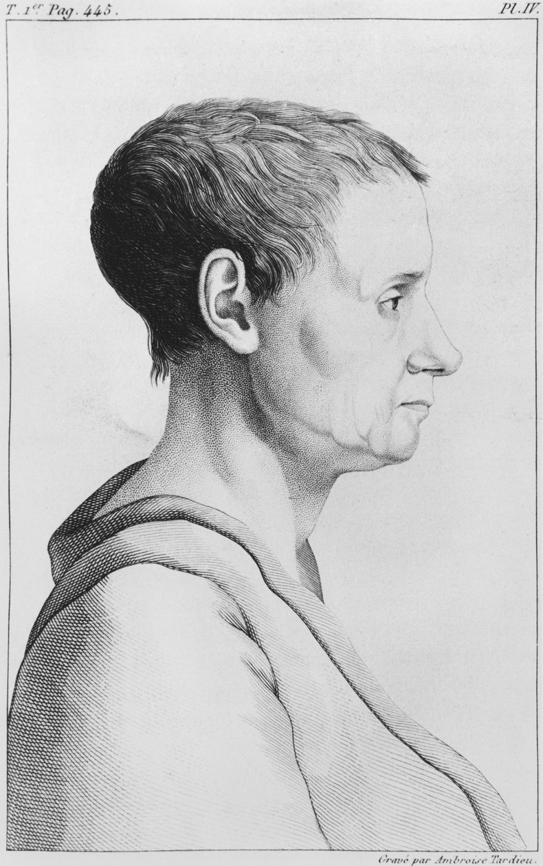 Theroigne de Mericourt，来自Etienne Esquirol（1772-1840）第四版，1838年的&39;精神疾病被认为是医疗，卫生和医疗法律&39;的插图 作者 安布罗斯·塔迪厄（Ambroise Tardieu）