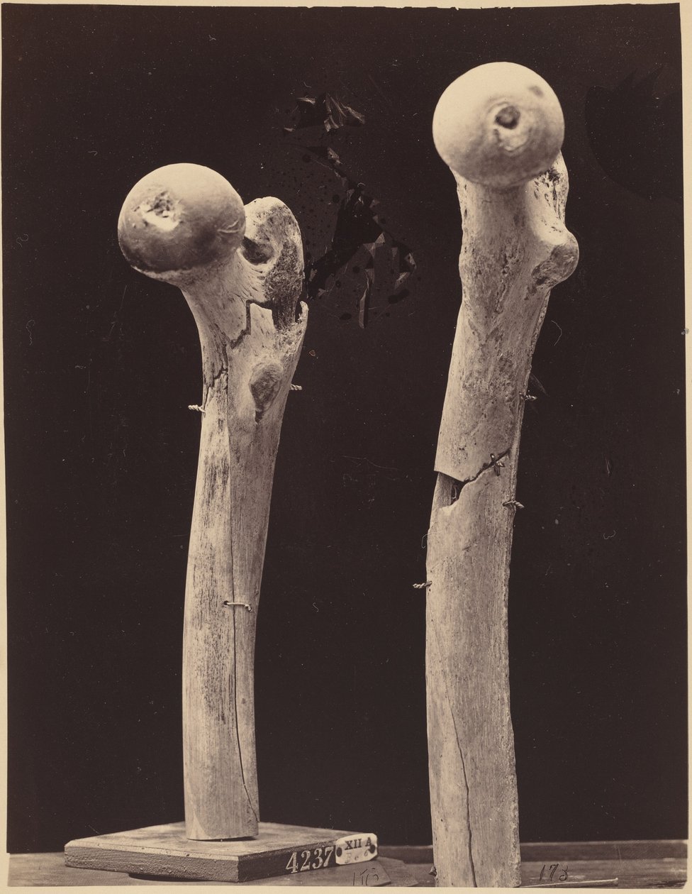 股骨枪伤骨折标本，约 1867 年（照片1867 年（照片） 作者 美国摄影师