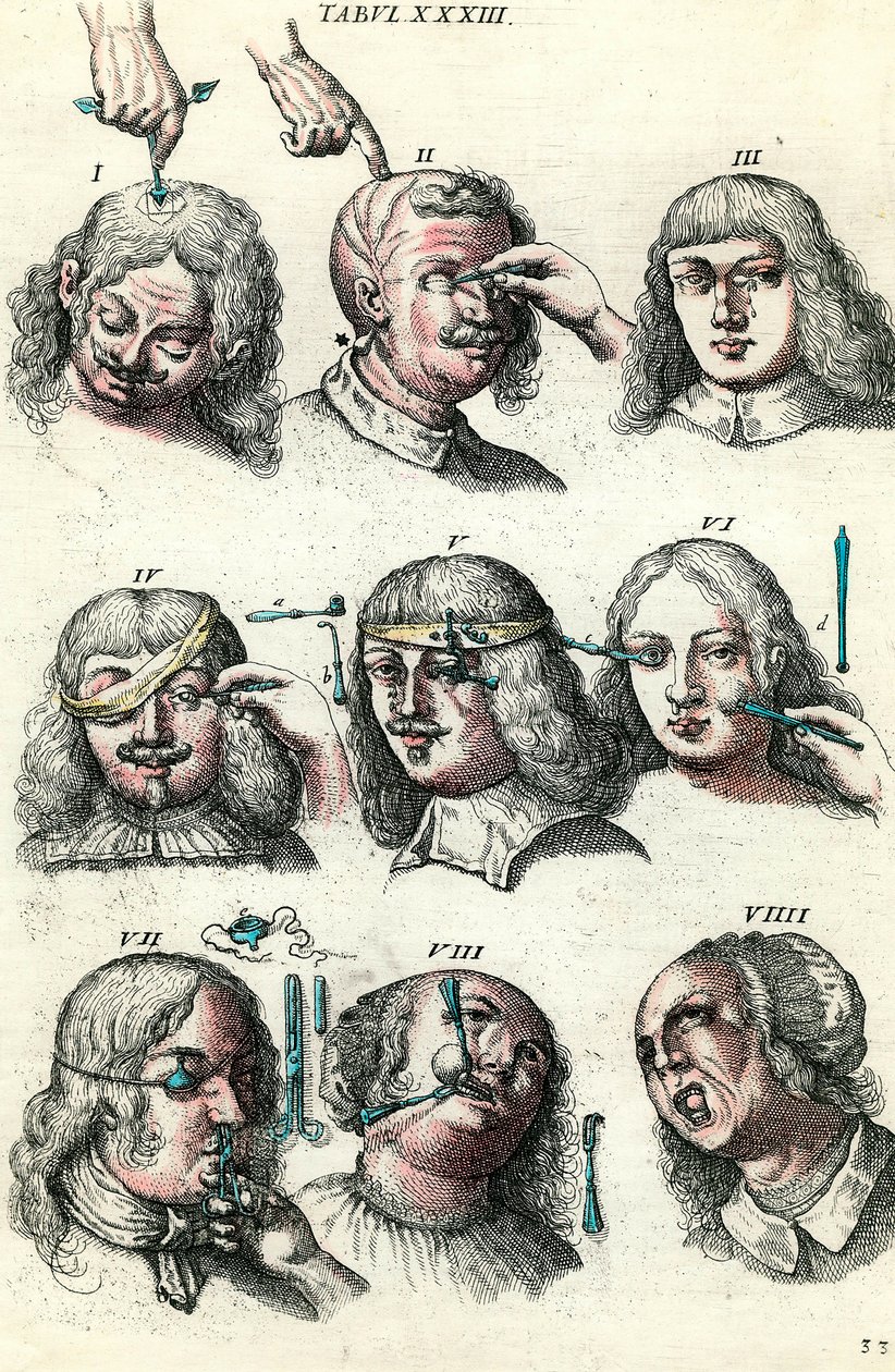Surgery in the 18th century: Trepanation and operation of the eye and face. Engraving in “Institutionis chirurgicae” by Lorenzo Heister 作者 匿名匿名