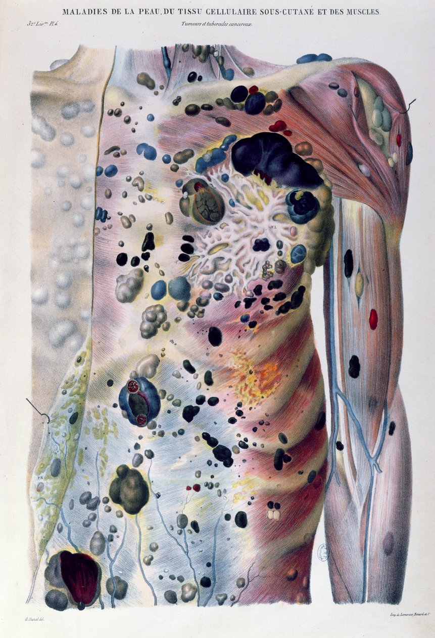 肿瘤和癌性结节，来自“人体病理解剖学”，作者：Jean Cruveilhier（1791-1874）1828-42 作者 安托万·查扎尔（Antoine Chazal）