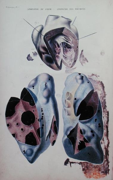 心脏和肺部窒息症，插图来自让-克鲁维耶（Jean Cruveilhier）（1791-1874）的《人体解剖学》，在巴黎出版。 作者 安托万·查扎尔（Antoine Chazal）