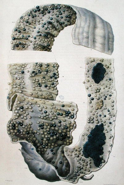 肠道疾病，摘自让-克鲁维耶（Jean Cruveilhier）（1791-1874）1828-42的《人体解剖学》（彩色雕刻）。 作者 安托万·查扎尔（Antoine Chazal）