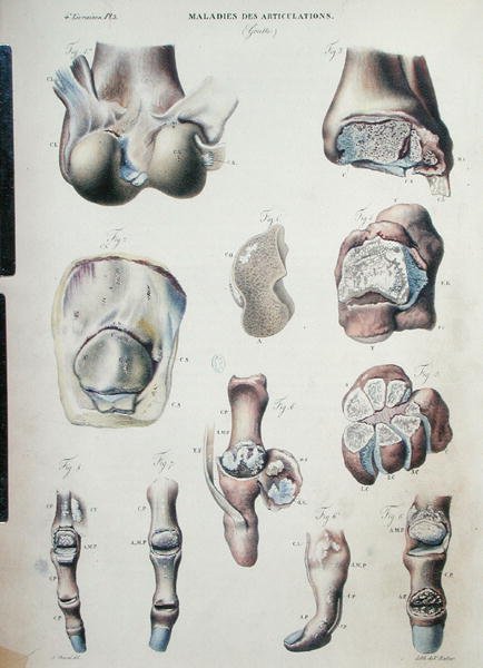 关节疾病，摘自Jean Cruveilhier (1791-1874) 1828-42的《人体解剖学》（彩色版画）。 作者 安托万·查扎尔（Antoine Chazal）