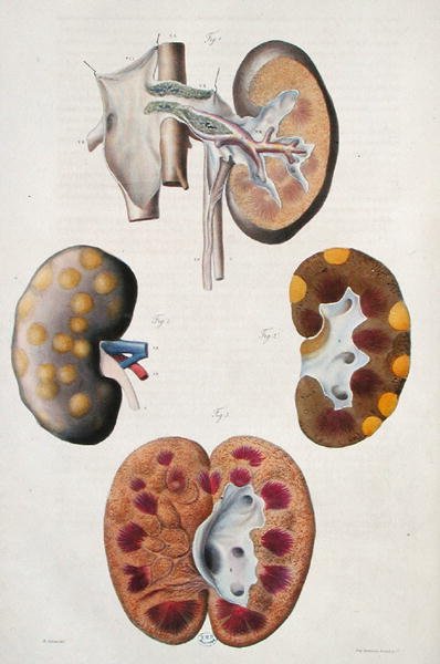 肾脏疾病，摘自让-克鲁维耶（Jean Cruveilhier）（1791-1874）1828-42的《人体解剖学》（彩色雕刻）。 作者 安托万·查扎尔（Antoine Chazal）