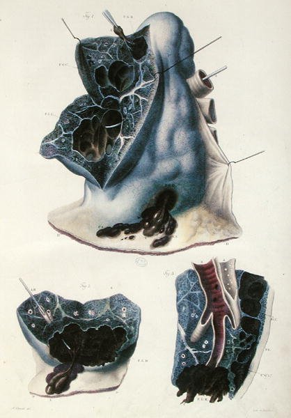 肺部疾病，摘自让-克鲁维耶（1791-1874）的《人体解剖学》，1828-42（彩色雕刻）。 作者 安托万·查扎尔（Antoine Chazal）