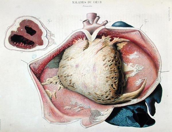心包炎，描述心脏疾病的板块，出自让-克鲁维耶（Jean Cruveilhier，1791-1874）的《人体解剖学》，在巴黎出版。 作者 安托万·查扎尔（Antoine Chazal）