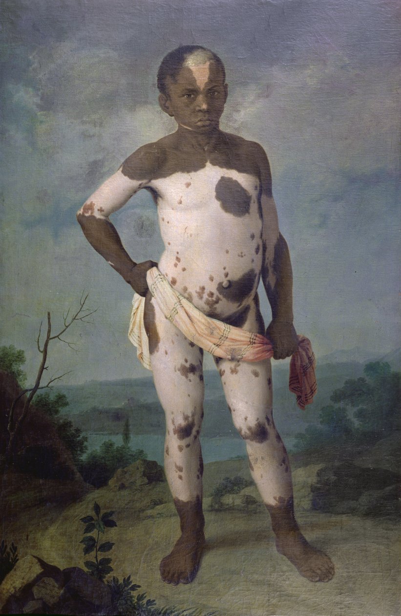 患有白癜风的孩子，1786年 作者 巴西学校