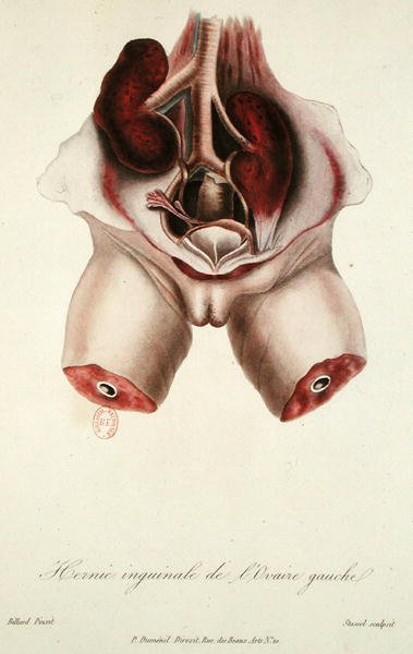 左侧卵巢的腹股沟疝，摘自《新生儿和产妇疾病手册》，作者是Charles-Michel Billard，由Stassel刻制。 作者 查尔斯·米歇尔（后）台球