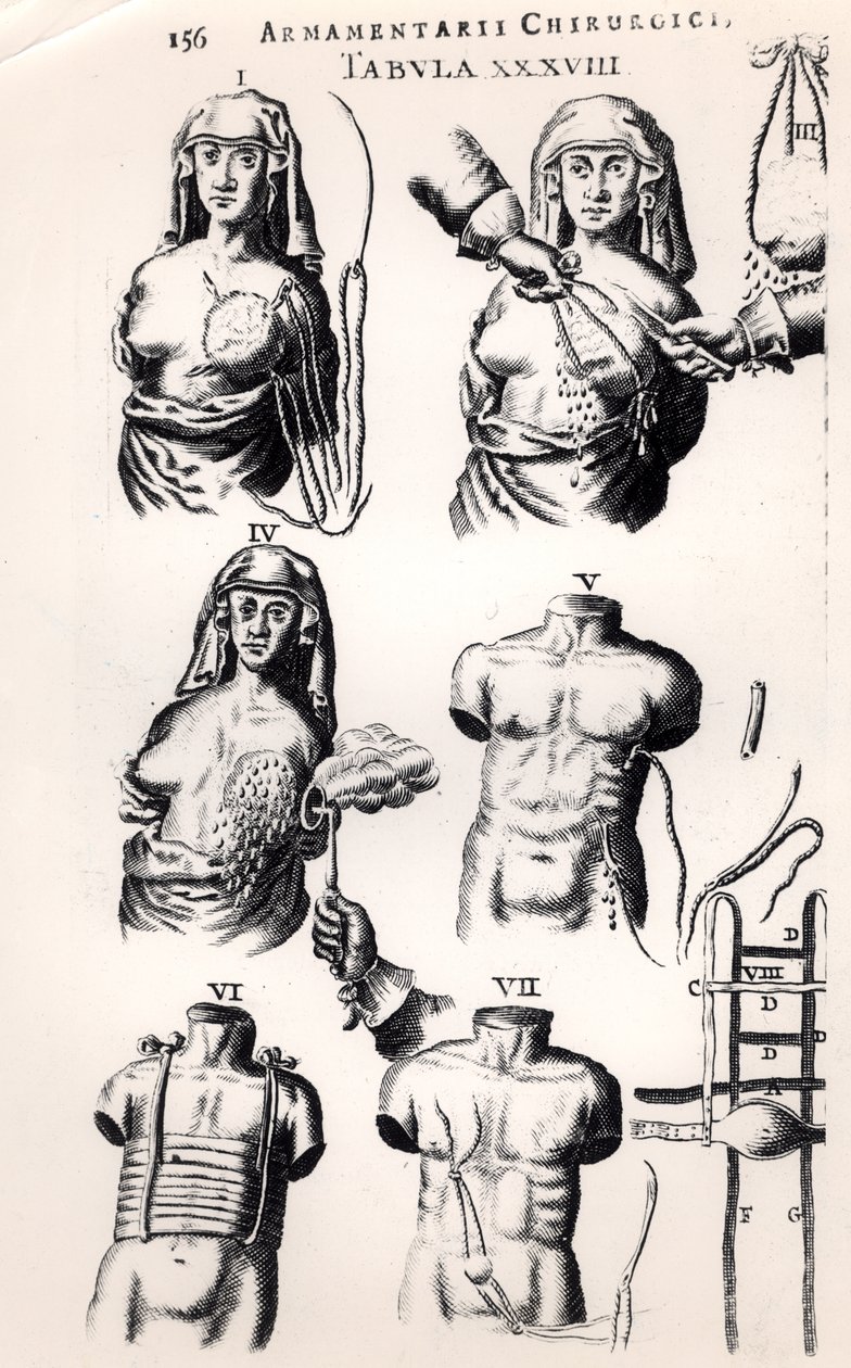 手术于乳腺癌，来自Armamentarii Chirurgici，Johannes Schultes（1595-1645）于1672年在阿姆斯特丹出版 作者 荷兰学校