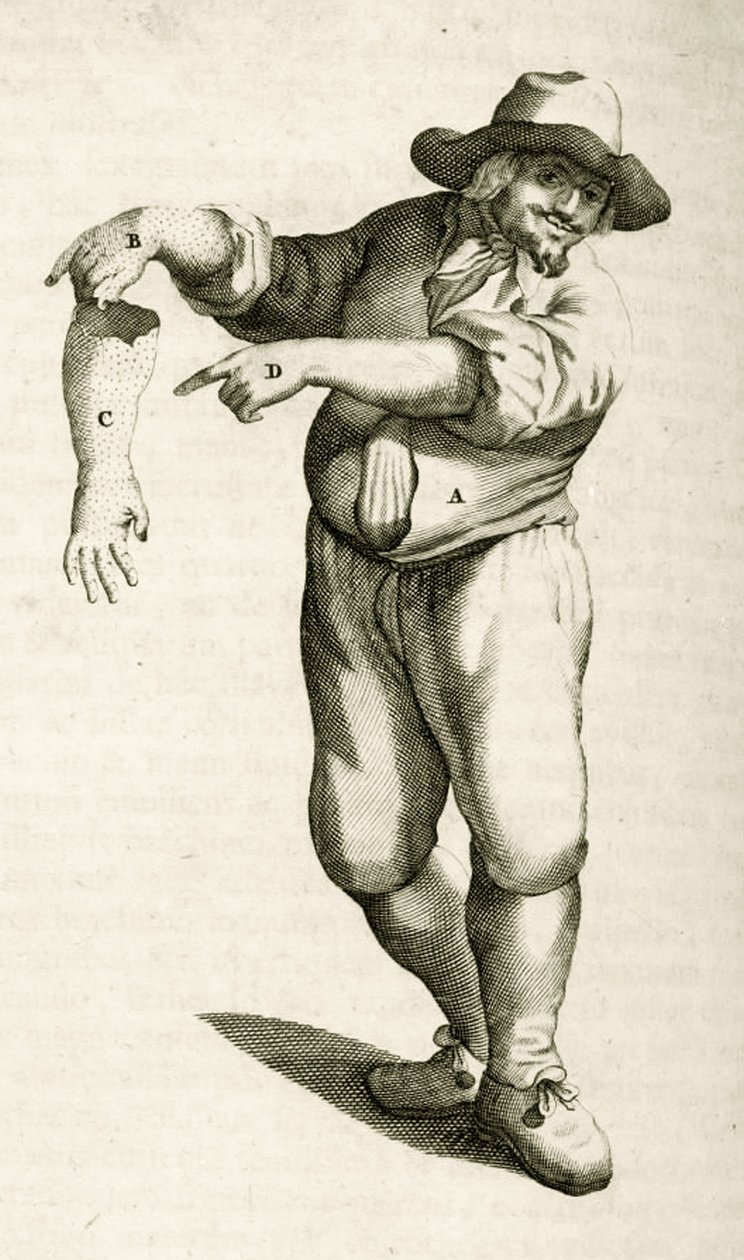 去除死皮脓疱，从实际演练由弗雷德里克·德克斯，1694治愈方法 作者 荷兰学校