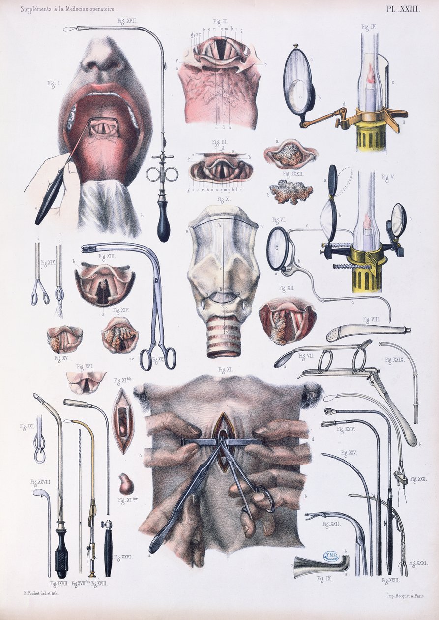 气管切开手术，由Jean-Baptiste Marc Bourgery撰写的“人类解剖学完整论述”（1797-1849）1866-67 作者 E.波切特