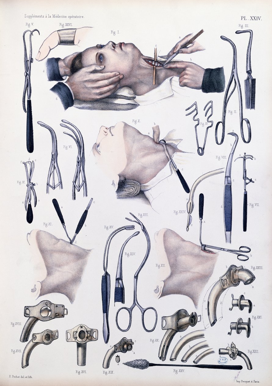 气管切开手术，由Jean-Baptiste Marc Bourgery撰写的“人类解剖学完整论述”（1797-1849）1866-67 作者 E.波切特