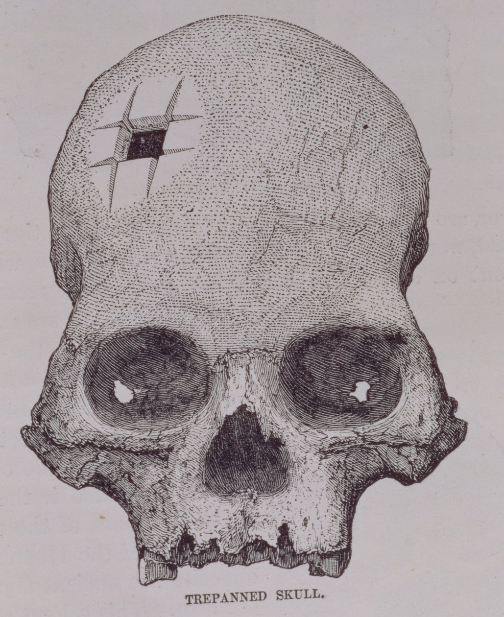 来自“印加人的旅行和探险事件”的Trepanned Skull，作者：E. George Squier，酒吧。在1878年 作者 英语学校
