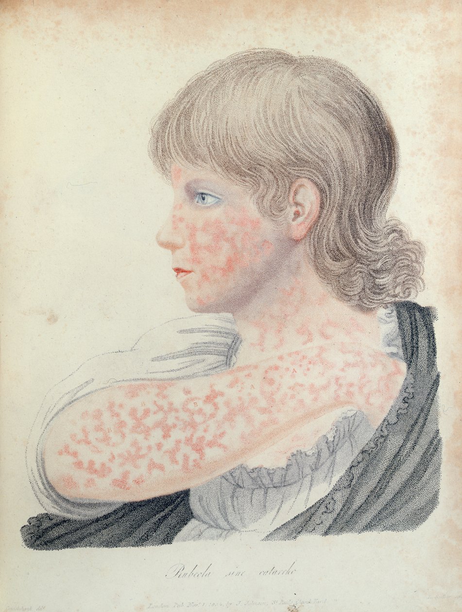 德国麻疹，Robert Willan（1757-1812）的书籍插图，1808年（彩色雕刻） 作者 英语学校