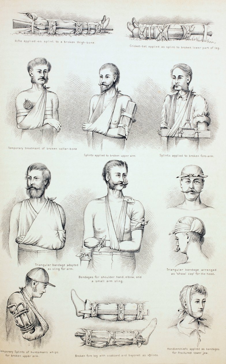 临时治疗骨折，c.1890 作者 英语学校