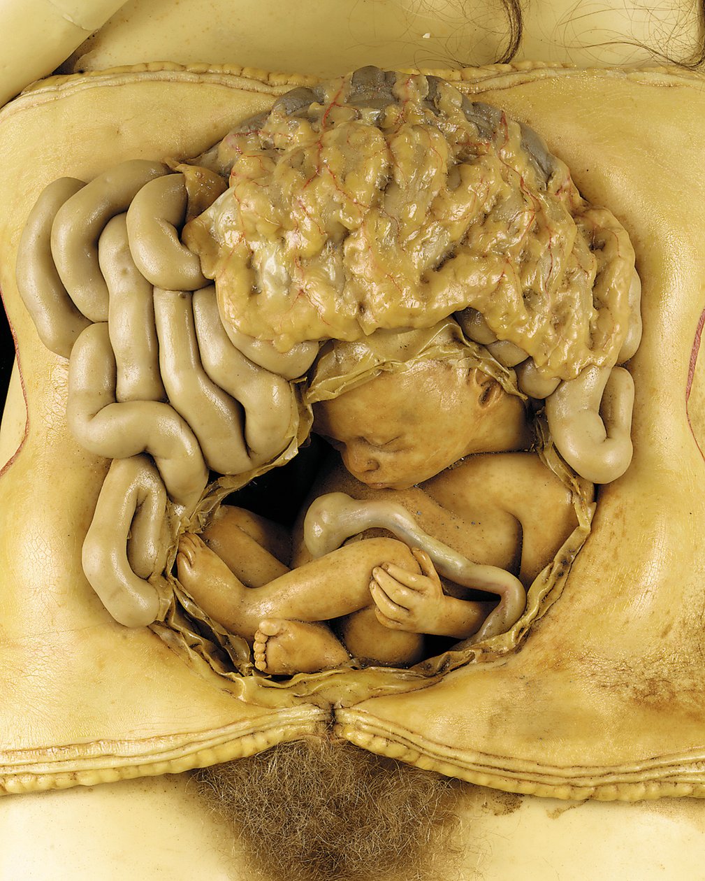 Anatomical model of an ovarian pregnancy, detail (wax) (see also 1126545-7) 作者 欧洲学校