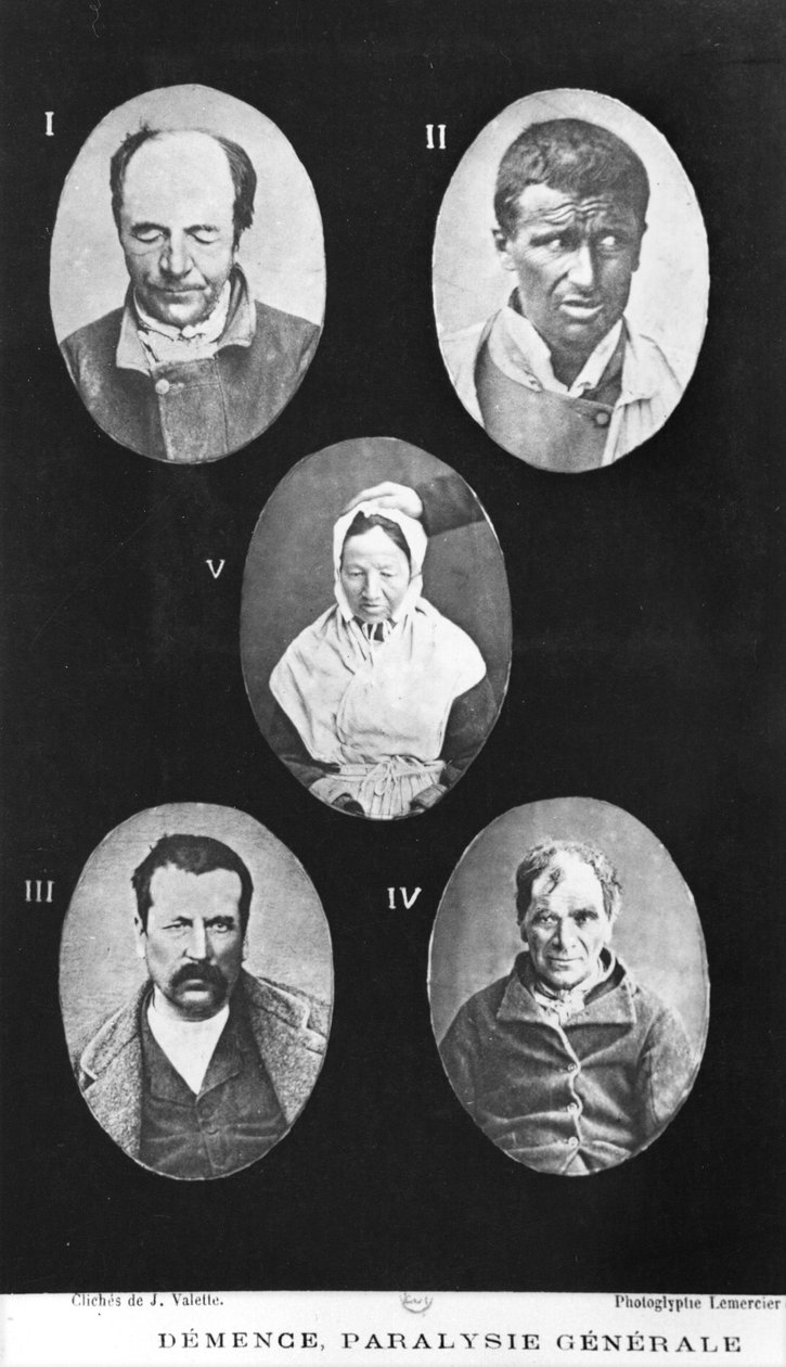 老年痴呆症，一般麻痹，新基本和实际贩运精神疾病的插图Henri Dagonet（1823-1902）Paris，Bailliere，1876 作者 法国摄影师