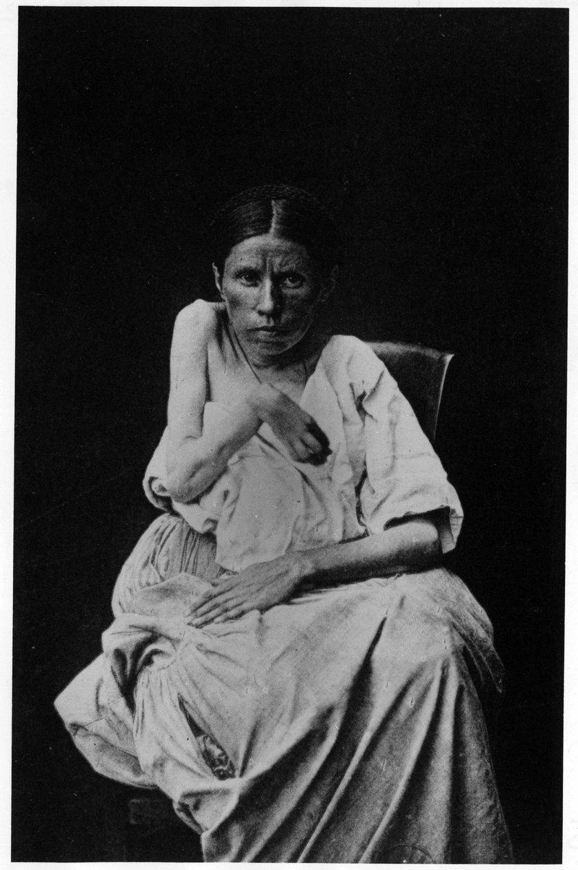 Photograph of a patient suffering from hemiplegic epilepsy, -in “” photographic iconography of the Salpetrière, Bourneville and P. Regnard, Paris 作者 法国摄影师
