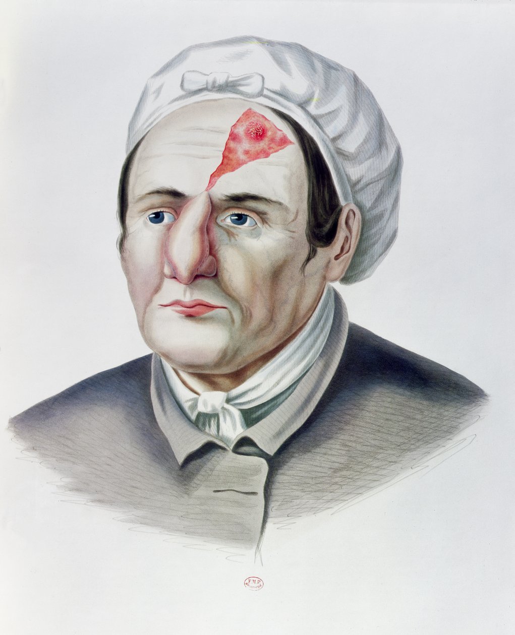 皮肤移植手术后，来自巴黎的Alexander Auvert的Selecta Praxis Medico-Chirurgica，1856年 作者 法语学校