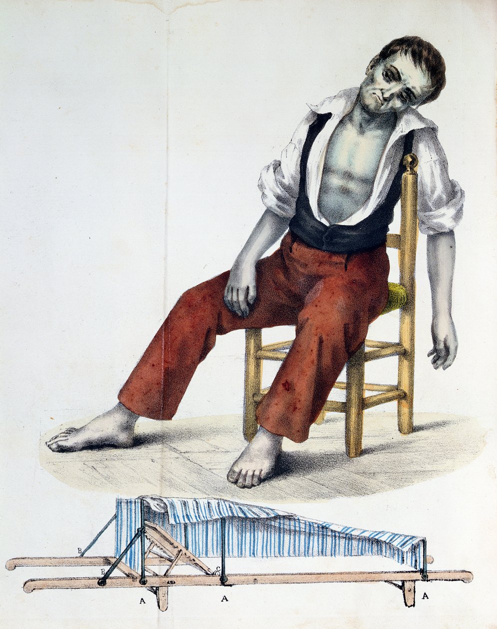 Cholera Morbus，来自霍乱与历史，统计和医疗的霍乱 -  Morbus由Francisco dAssis de Souza Vaz，1833年 作者 法语学校