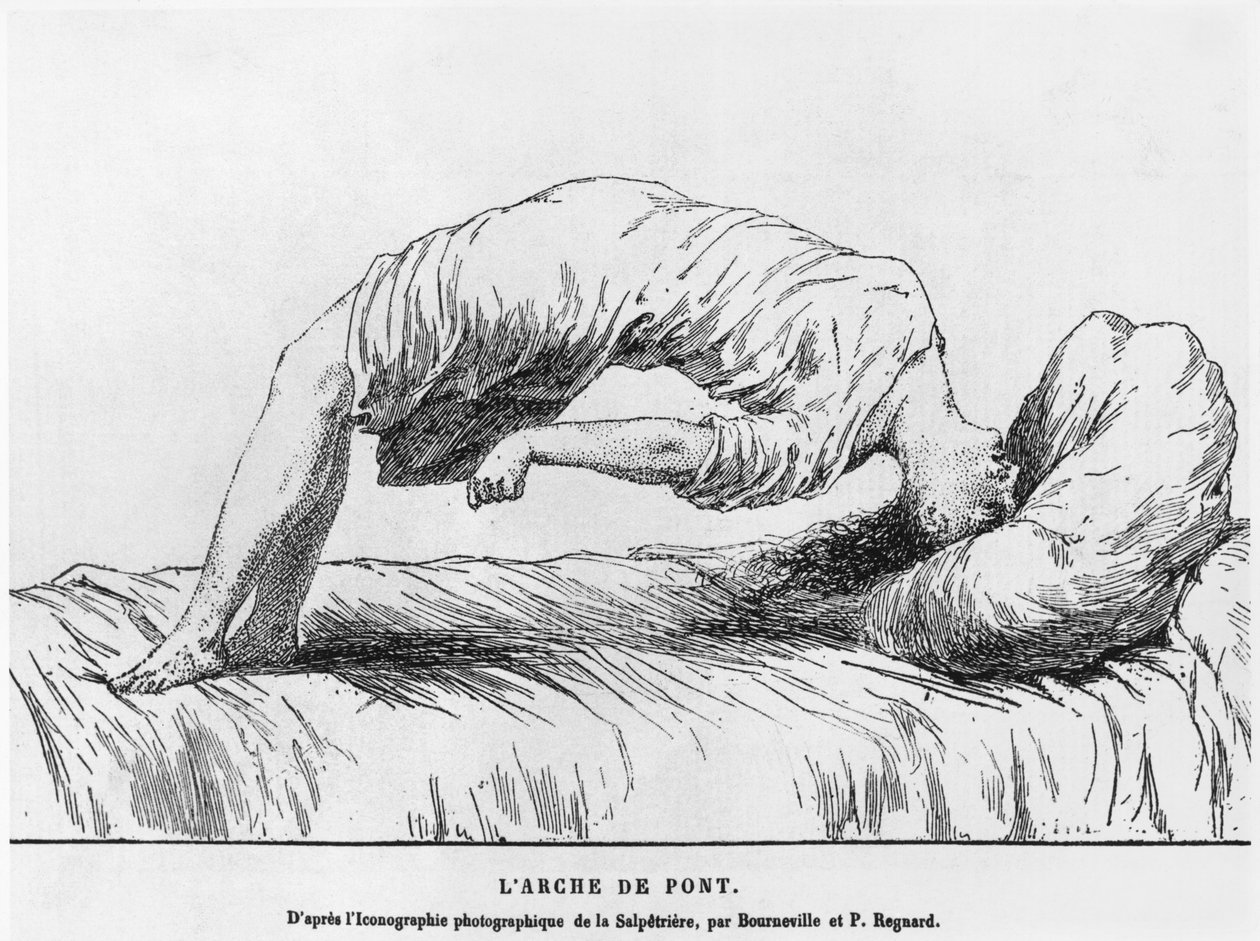 Hysteria和梦游症，来自Les Maladies Epidemiques de lEsprit by Paul Regnard（1850-1927）1884 作者 法语学校