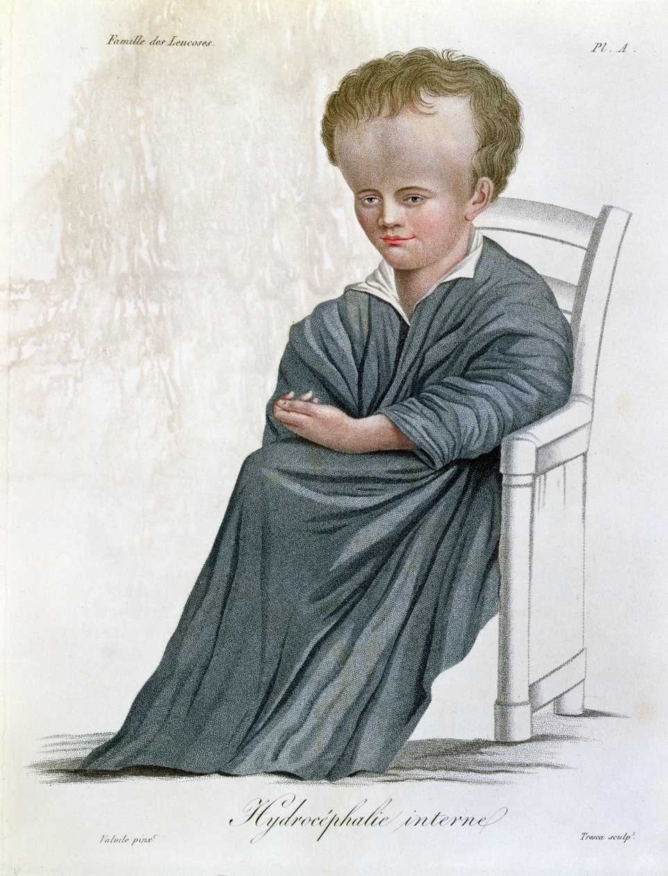 内部脑积水，来自Nosologie Naturelle by Baron Jean Louis Alibert（1768-1837），由Tresca雕刻，1817年 作者 法语学校