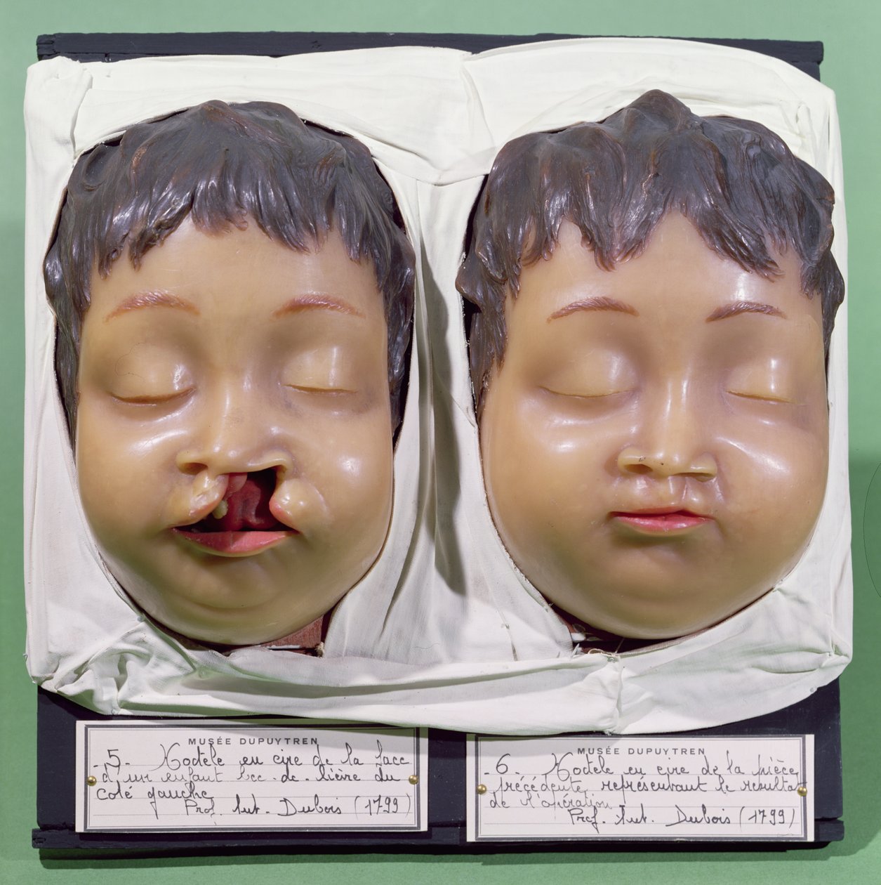 模特展示了一个孩子的脸，在1799年由Antoine Dubois（1756-1837）执行的操作之前和之后纠正了一个harelip（蜡） 作者 法语学校