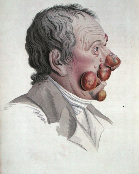 Fongoide霉菌病，摘自Jean Louis Alibert男爵（1768-1837）的著作 1838年（彩色雕刻）。 作者 法语学校