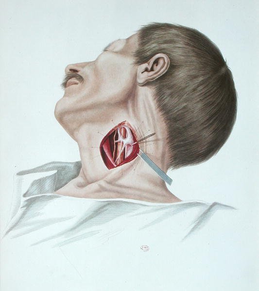 动脉瘤手术，摘自Alexander Auvert的 "Selecta Praxis Medico-Chirurgica"，巴黎。 作者 法语学校