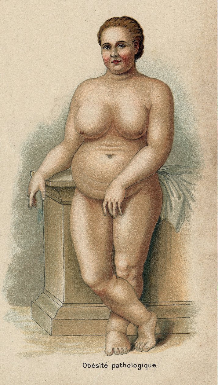 病理肥胖症妇女肖像（印刷品） 作者 法语学校