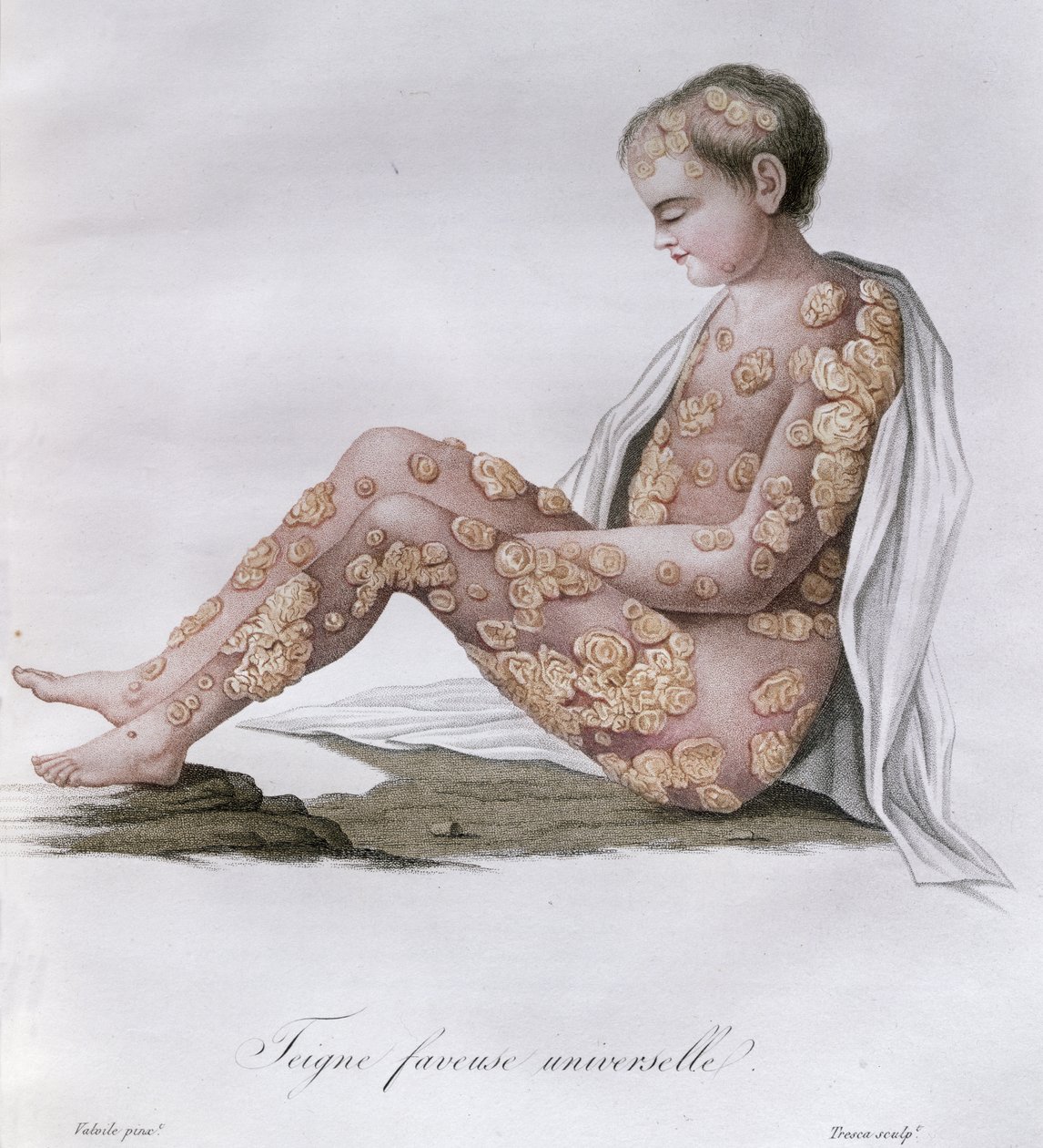 癣，来自男爵Jean Louis Alibert（1768-1837）1838年出版的一本书 作者 法语学校
