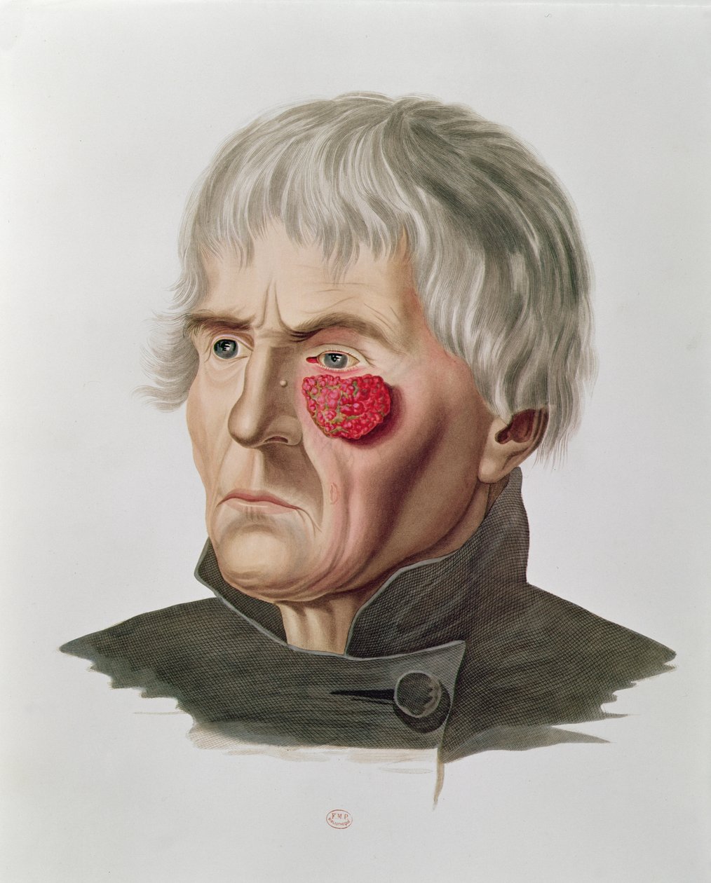 手术前的皮肤病，来自巴黎的Alexander Auvert的Selecta Praxis Medico-Chirurgica，1856年 作者 法语学校