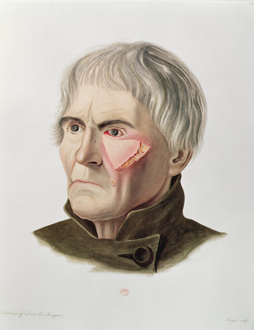 皮肤移植手术，来自巴黎的Alexander Auvert的Selecta Praxis Medico-Chirurgica，1856年 作者 法语学校