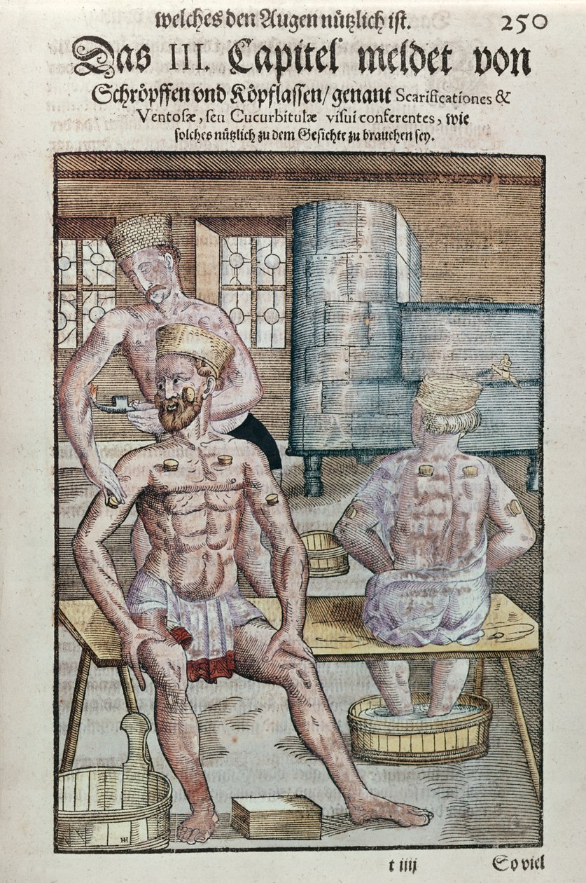 拔罐，来自Ophthalmodouleia的Georg Bartisch（1535-1636）于1583年在德累斯顿出版（彩色木版画） 作者 德国学校