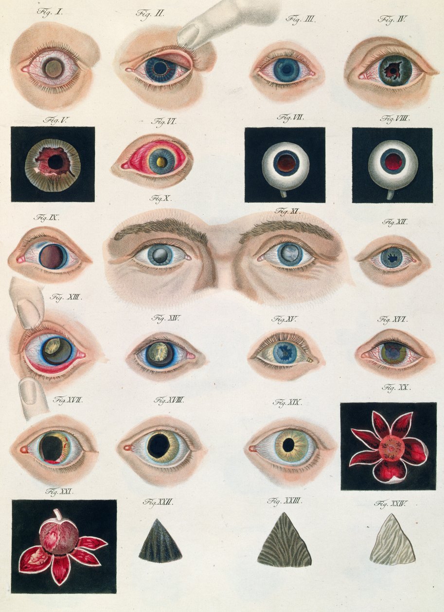 先天性眼睛异常的描述，来自疾病的临床表现和Mesnschlichen眼的致盲错误，作者：Friedrich August von Ammon（1799-1861）1838 作者 德国学校