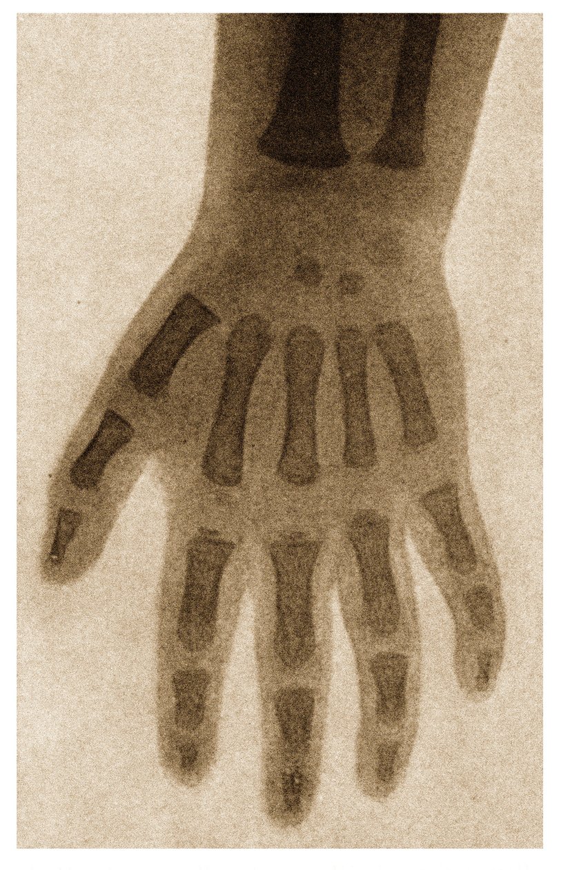 X射线的孩子手c.1890 作者 德国学校