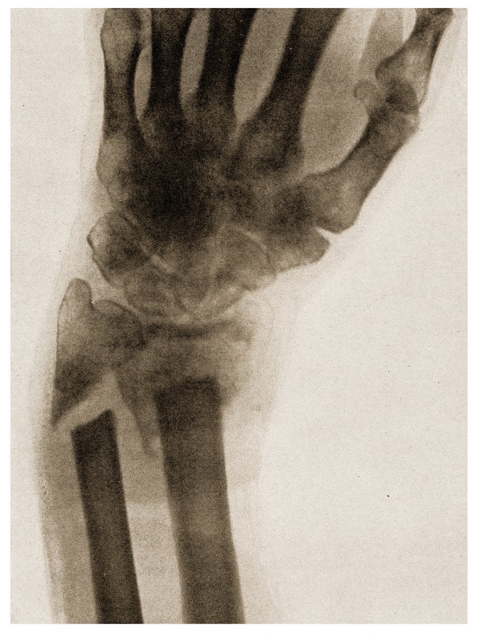 手腕骨折的X射线c.1890 作者 德国学校