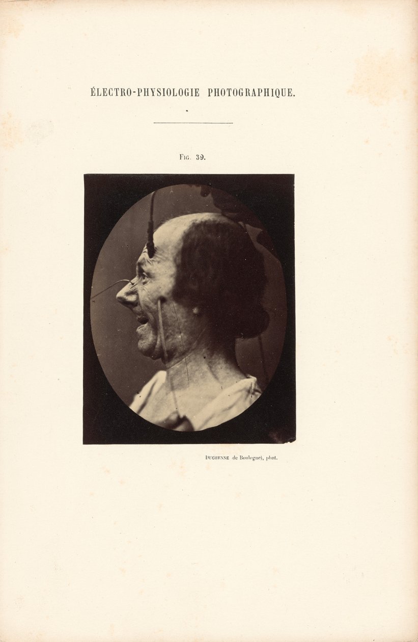 摄影电生理学，图 39 作者 纪尧姆·本杰明·杜兴（Guillaume Benjamin Duchenne）