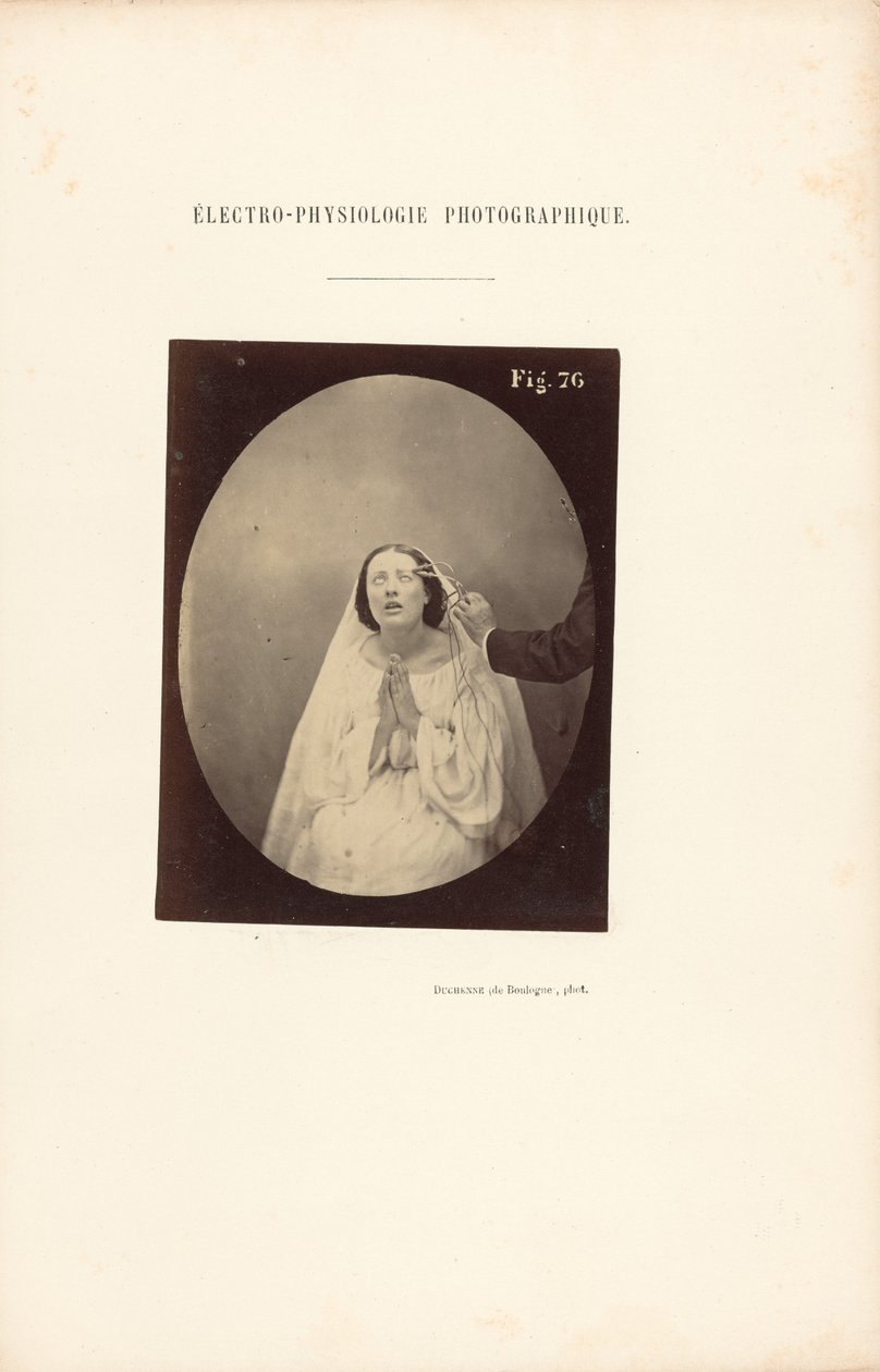 摄影电生理学，图 76 作者 纪尧姆·本杰明·杜兴（Guillaume Benjamin Duchenne）