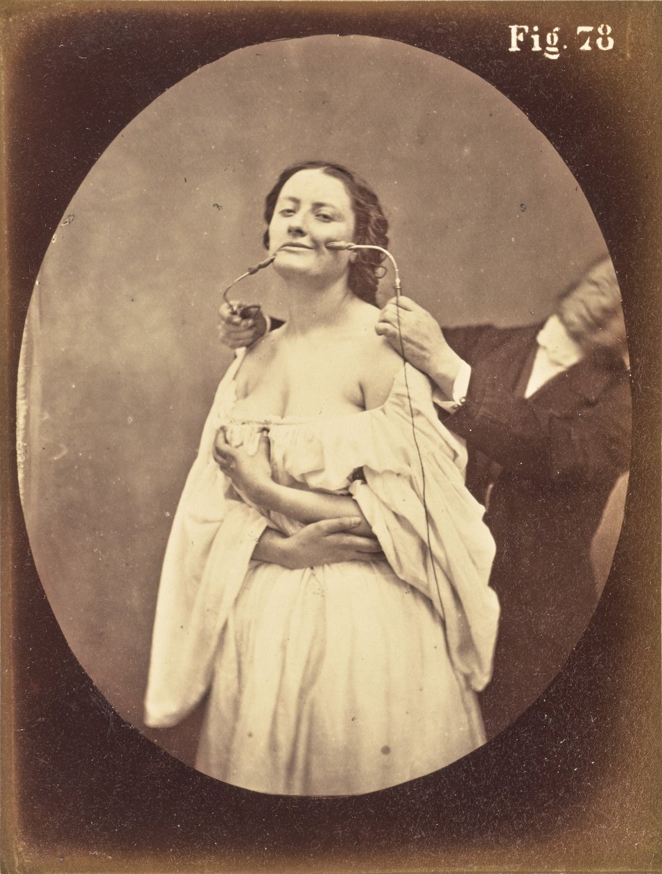 图78 作者 纪尧姆·本杰明·杜兴（Guillaume Benjamin Duchenne）