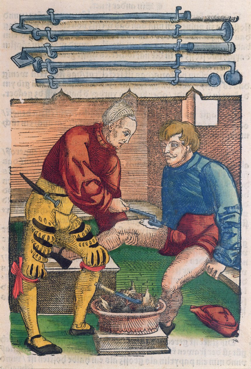 灼烧，来自&39;Feldartbuch der Wundartzney&39;的插图作者：Hans von Gersdorff，c.1540（彩色木版画） 作者 汉斯（Hans）或约翰内斯（Johannes Ulrich Wechtlin）
