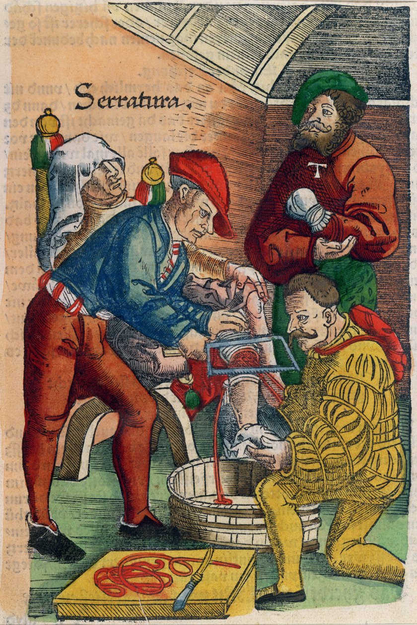 截肢术，插图来自&39;Feldartbuch der Wundartzney&39;，Hans von Gersdorff，c.1540（彩色木版画） 作者 汉斯（Hans）或约翰内斯（Johannes Ulrich Wechtlin）