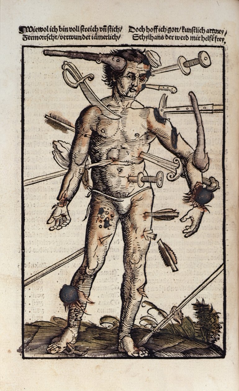 XVIIIv 《受伤的人》，选自汉斯-冯-格斯多夫的《Feldtbuch der Wundartzney》。 作者 汉斯（Hans）或约翰内斯（Johannes Ulrich Wechtlin）