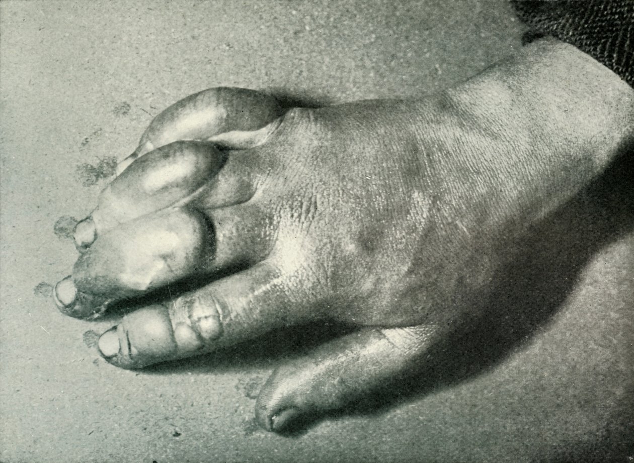 Atkinsons冻伤之手博士，1911年7月5日，1913年 作者 赫伯特·庞廷