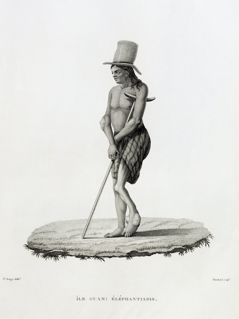 关岛：一个有象皮病的男人，来自“世界上的旅程，在1817年至1870年的乌拉尼亚护卫舰上”，由Choubard雕刻，1825年出版 作者 雅克·艾蒂安·维克多·阿拉戈