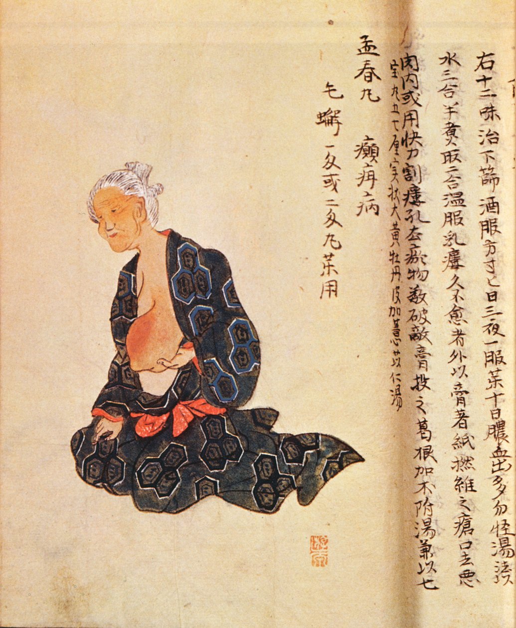 第一次手术治疗乳腺癌是由Seishu Hanaoka（1760-1836）在1804年在全身麻醉下进行的 作者 日本学校