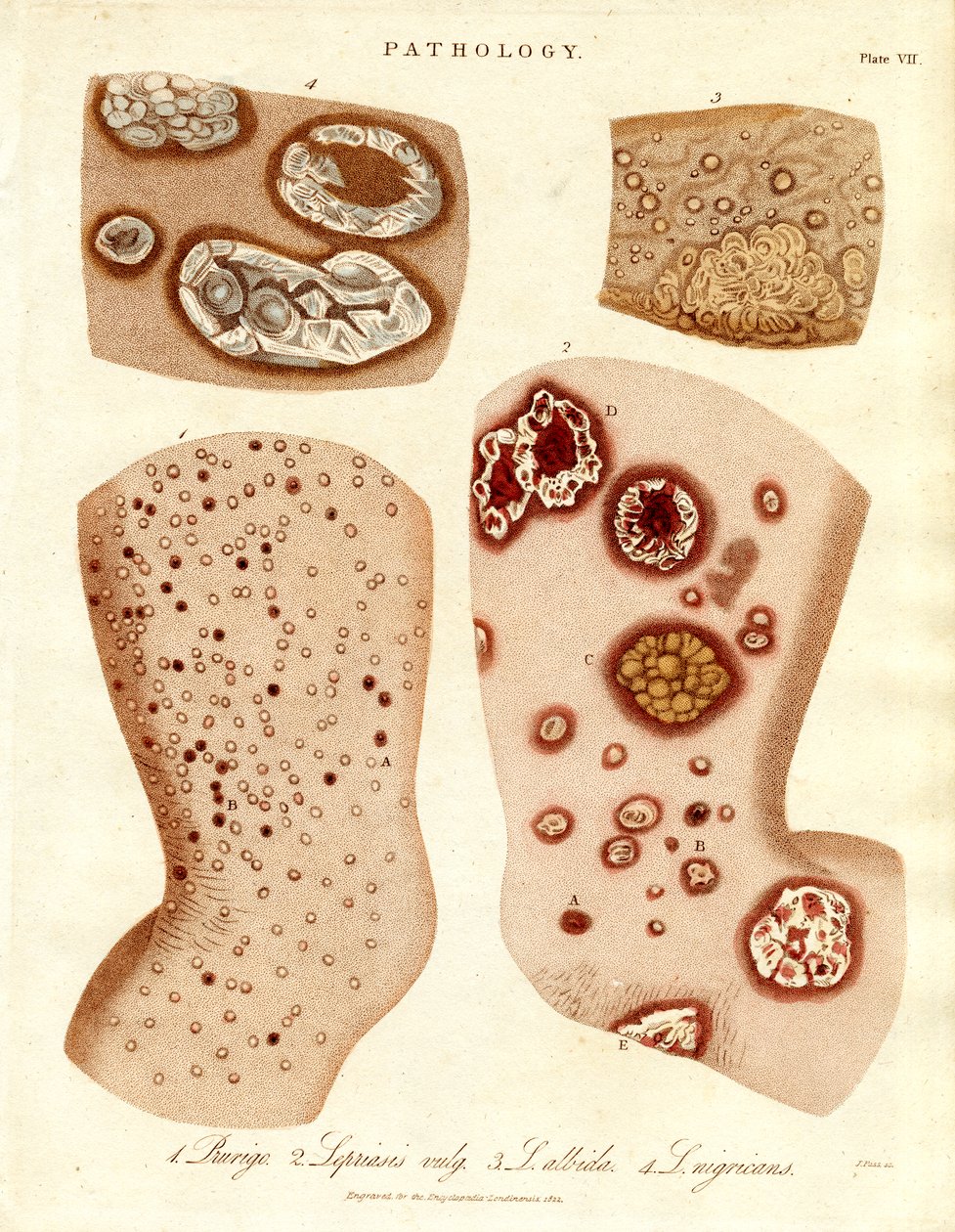 病理性皮肤病：Schurigie；Leprous Skin；Pallada 和 Impetigo 作者 约翰·帕斯