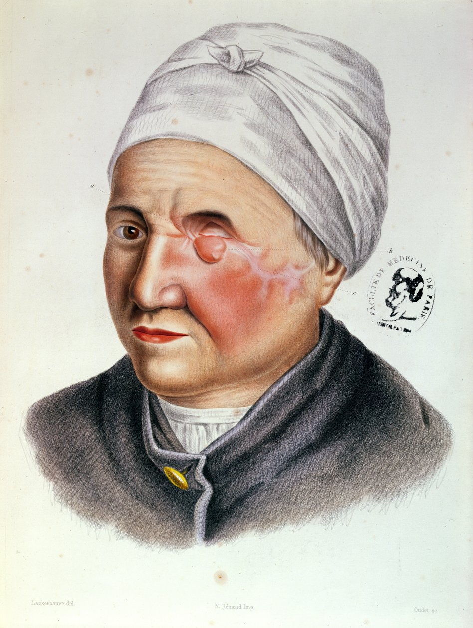 来自Antoine Jobert de Lamballe（1799-1867）巴黎的整容手术论文的插图，1849年 作者 画家生成器